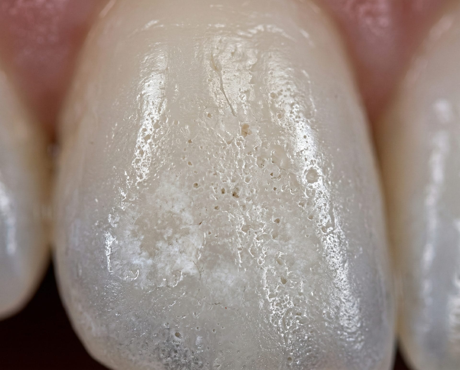 Hydroxyapatite powder for specific dental conditions — sensitivity, enamel erosion and whitening