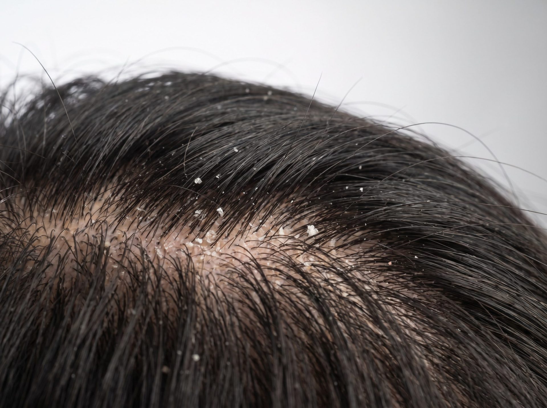 Natural anti-dandruff ingredients: tea tree, coconut oil, shampoo bar